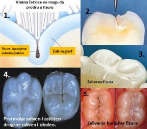 zalivanje fisura
